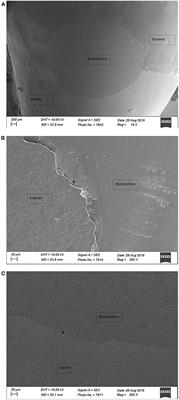 Effect of 9.3 μm CO2 and 2.94 μm Er:YAG Laser vs. Bur Preparations on Marginal Adaptation in Enamel and Dentin of Mixed Class V Cavities Restored With Different Restorative Systems